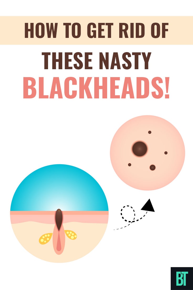 How to Get Rid of These Nasty Blackheads