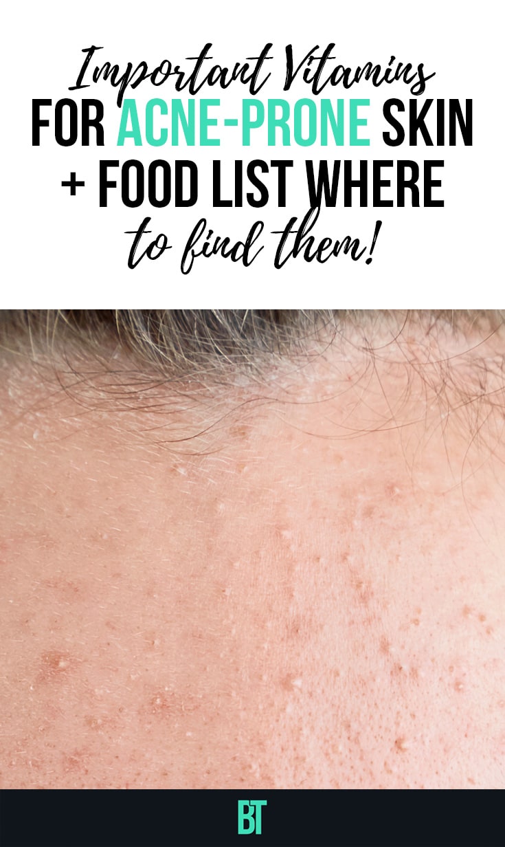 Minerals & Important Vitamins for Acne-Prone Skin + Food List