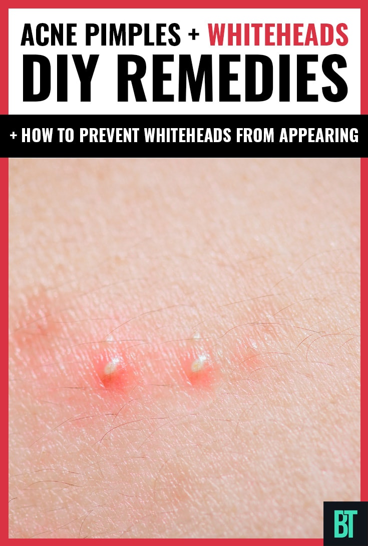Acne Pimples + Whiteheads DIY Remedies