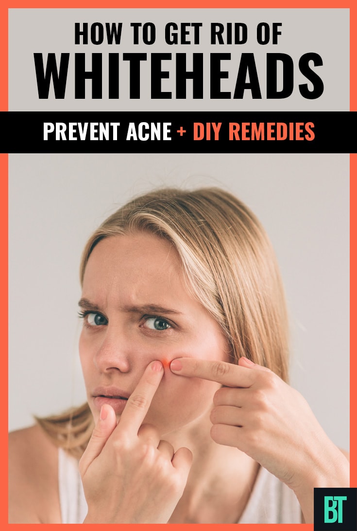 Whiteheads How to Get Rid of This Acne Problem