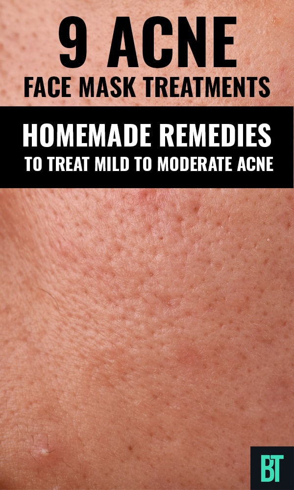 On home pimples face for remedies 10 Home