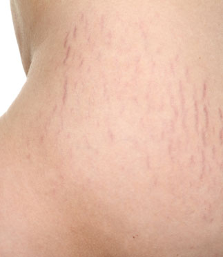 stretch marks