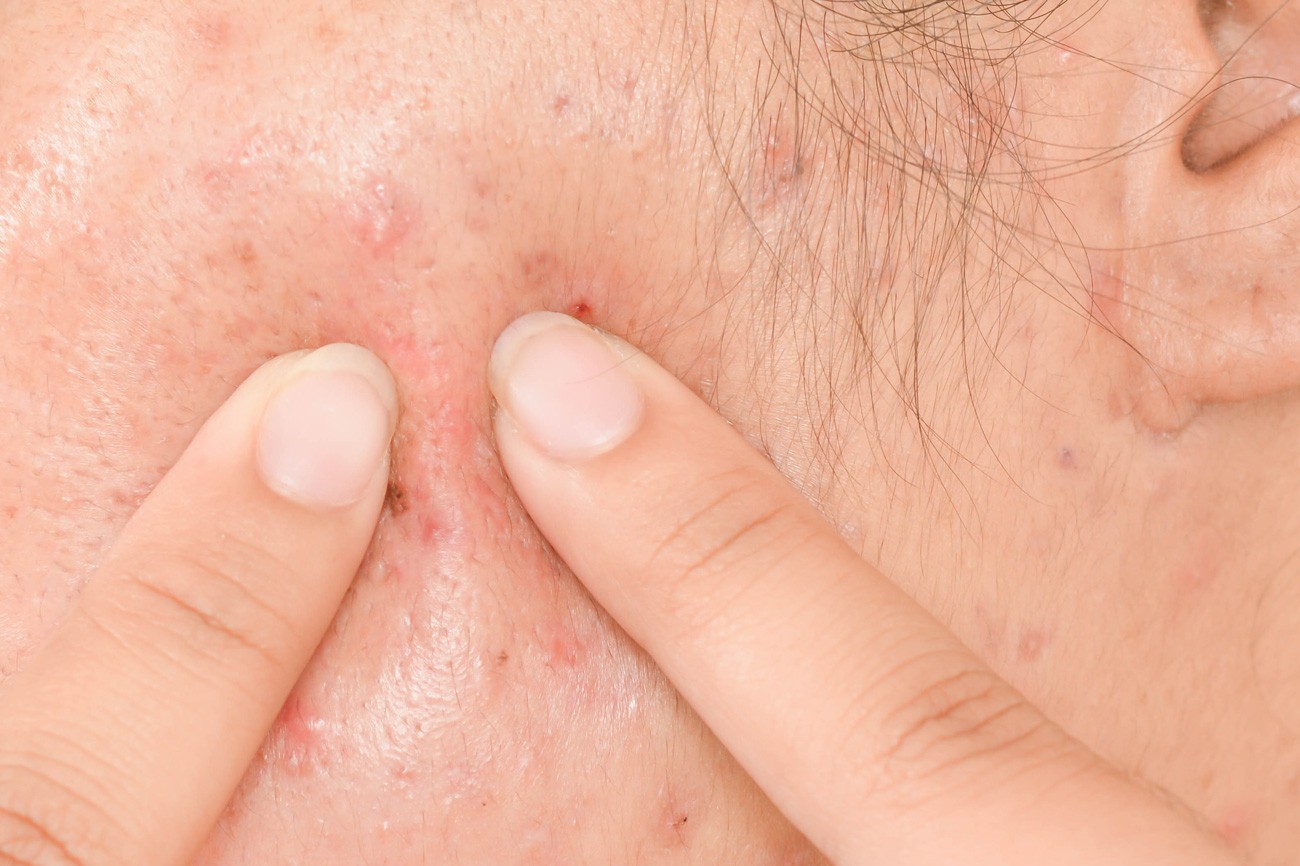 Woman with Acne Problem : Squeezing pimple
