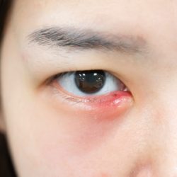 Eye Stye: Causes & 7 Best Home Remedies to Treat Eye Stye