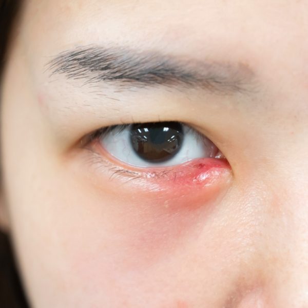 Eye Stye Causes & Home Remedies