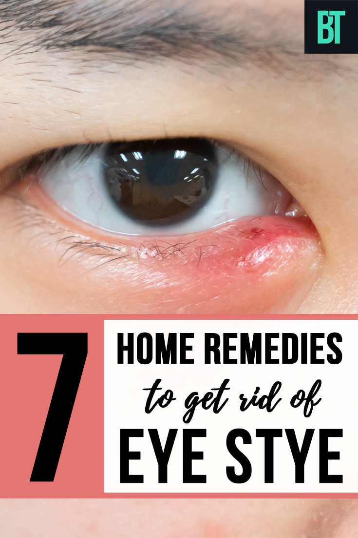 Home Remedies to Get Rid of Eye Stye