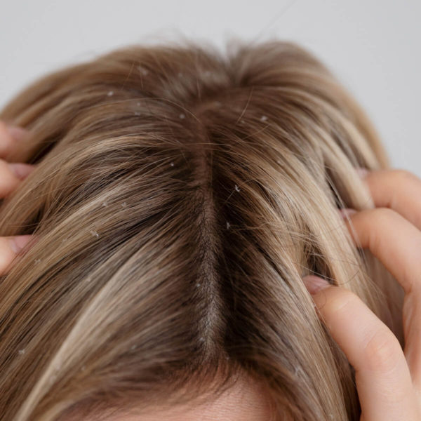 Woman with scalp buildup